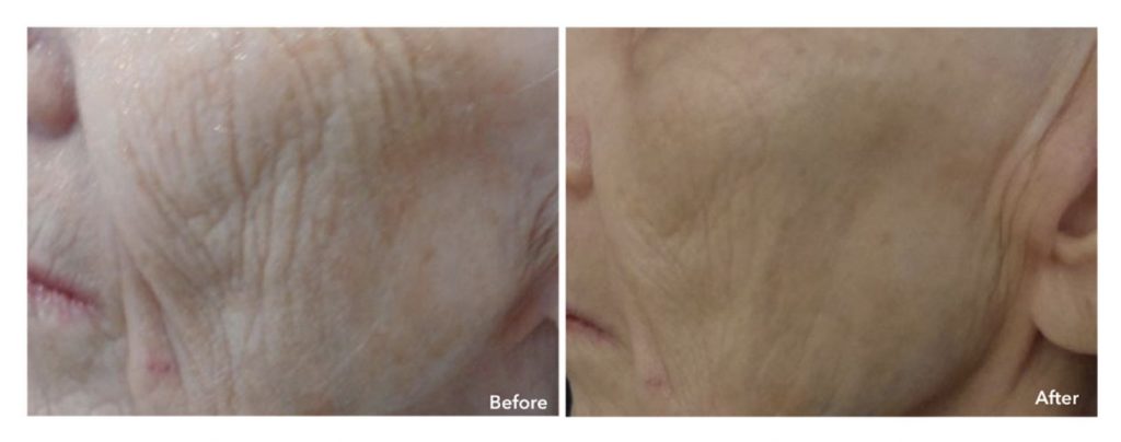 Stem Cell Microneedling Before and After